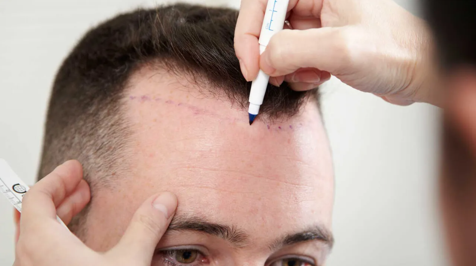 Hair Patch Service in Gurgaon | 8800411146 | Hair Patch Price